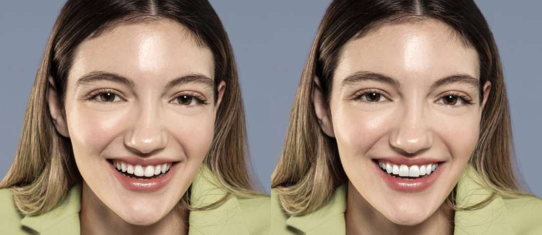 Veneers — example