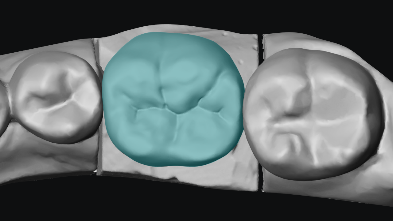 Adaptive AI crown design proposals shaped by the lab's own tooth library
