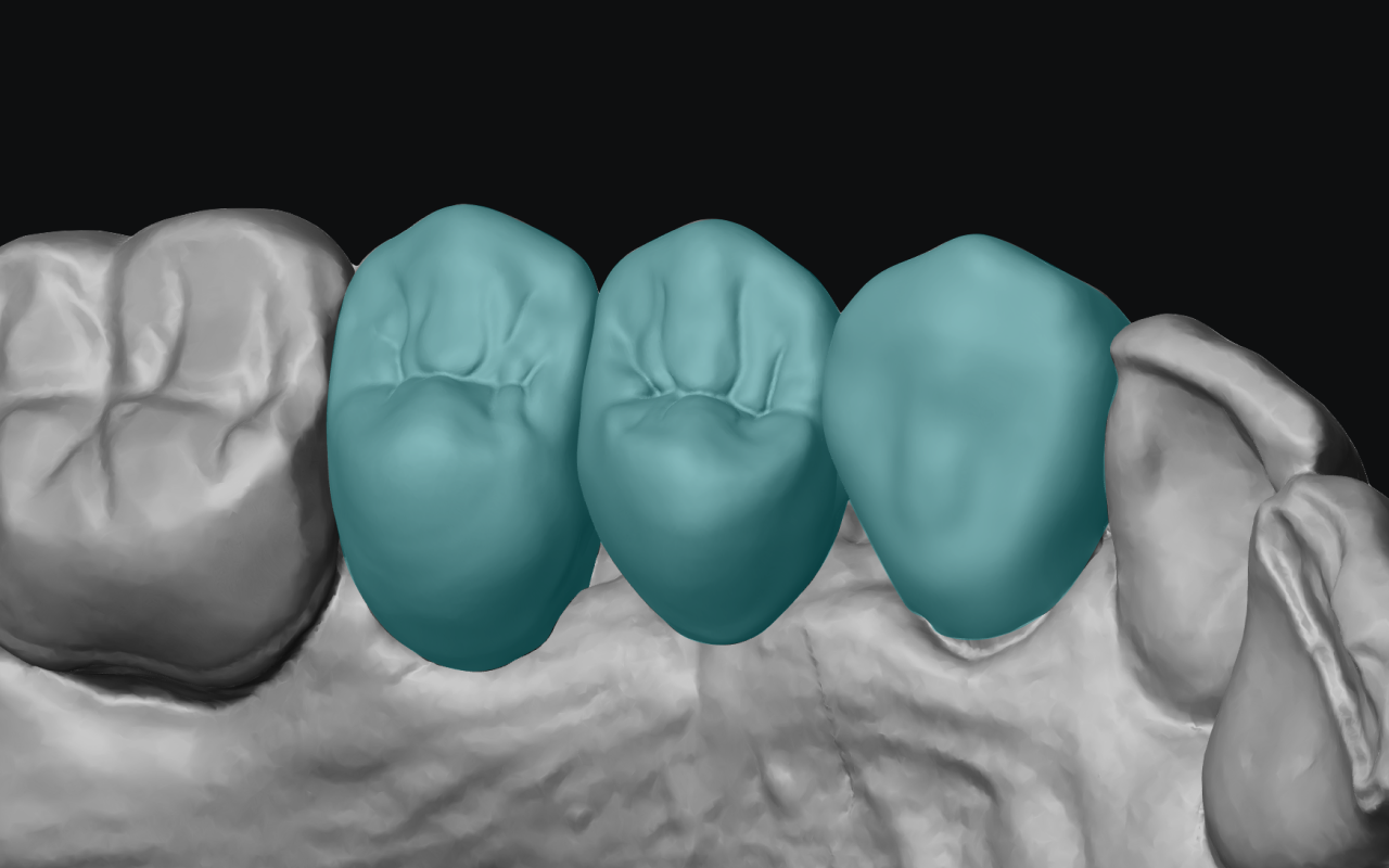 AI-designed multi-unit bridge highlighted in teal within a gray 3D scan