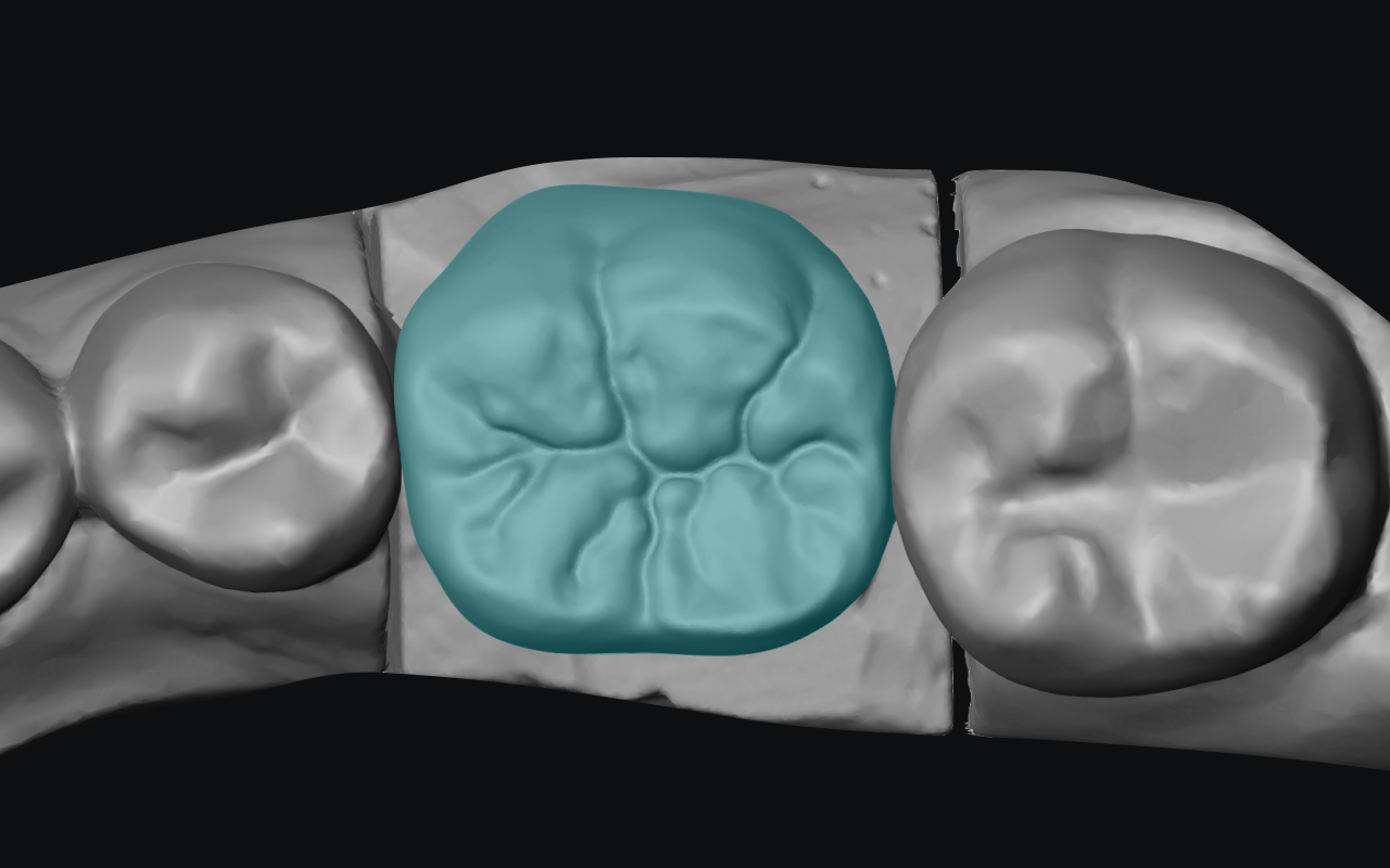 AI-designed crown highlighted in teal, seated on the prepared tooth within a gray 3D scan