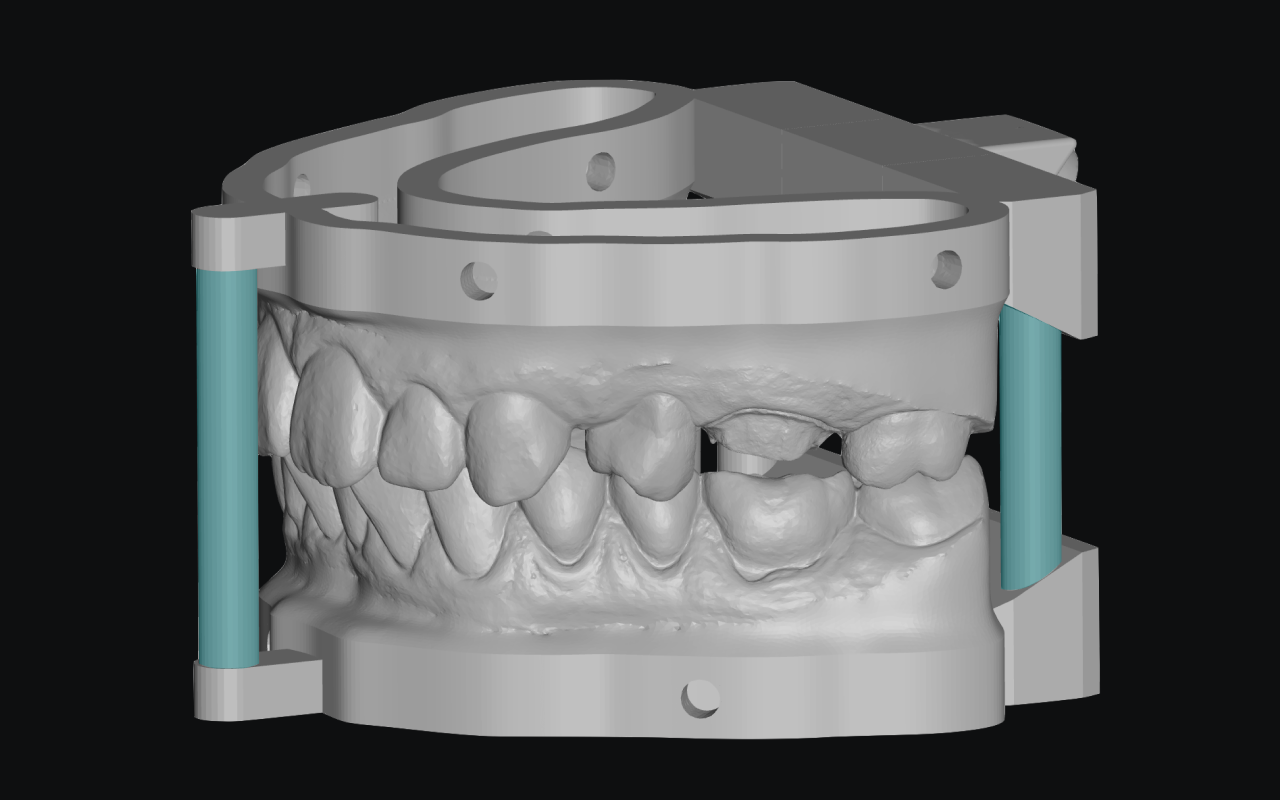 AI-generated print-ready working model built from an intraoral scan