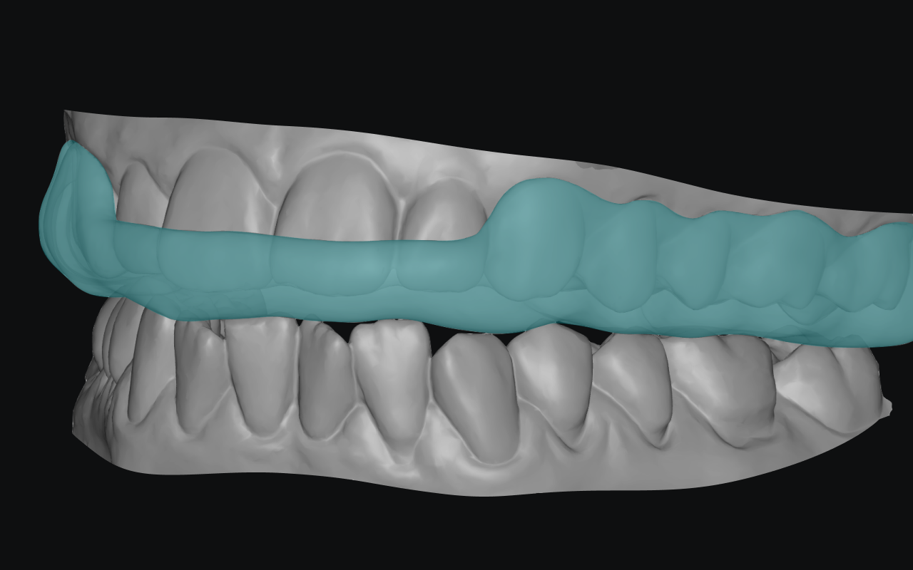 AI-generated occlusal splint with a smooth, even fitting surface