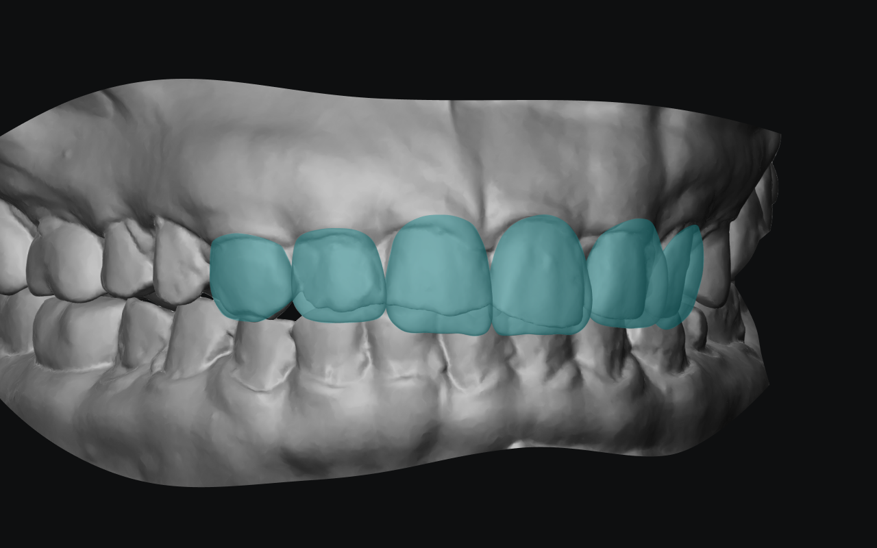 Full-anatomy digital wax-up highlighted in teal on a gray 3D scan