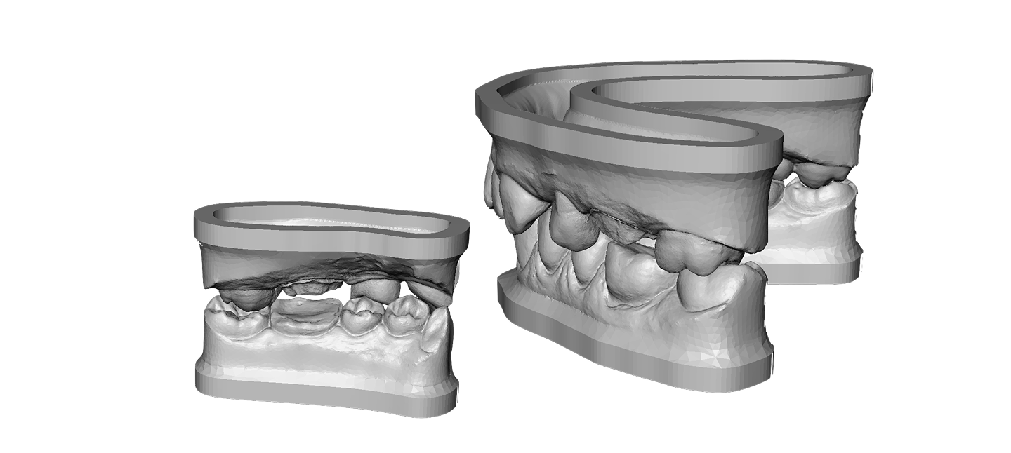 AI dental model generation — working model built up with pins and articulator, frame by frame