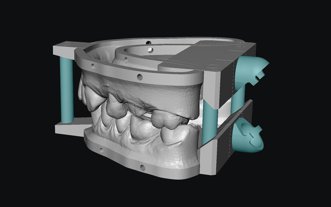 Working model mounted with alignment pins and a built-in articulator preset