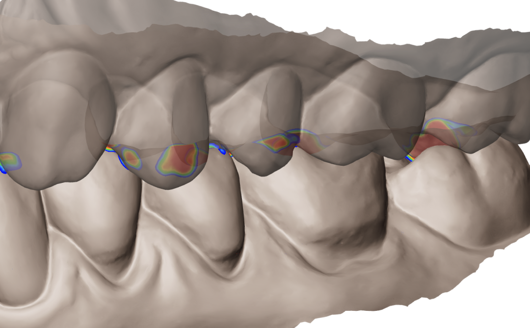 Articulated upper and lower 3D scans with heatmap marking bite contact and alignment errors