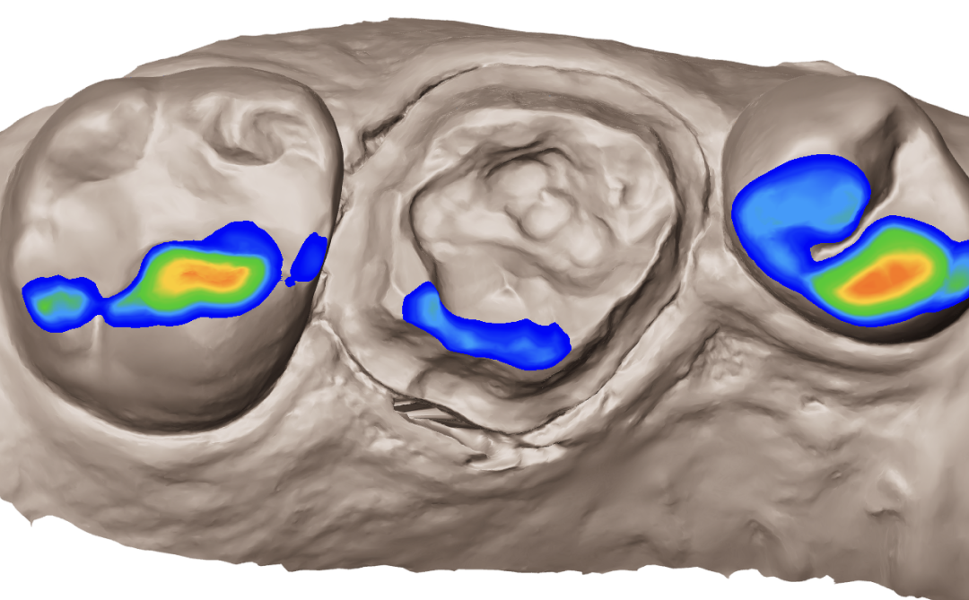 Occlusal view of a 3D dental scan with heatmap highlighting insufficient clearance around the prepared tooth