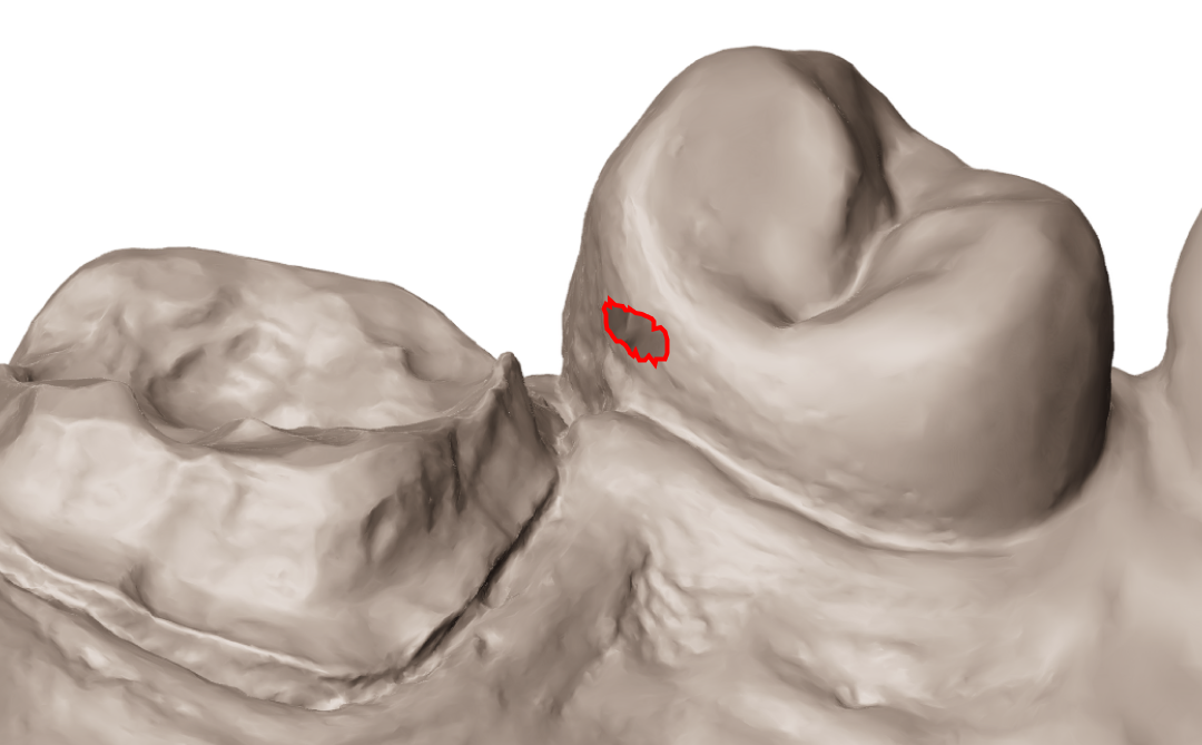 3D dental scan with a mesh hole defect outlined in red next to the prepared abutment