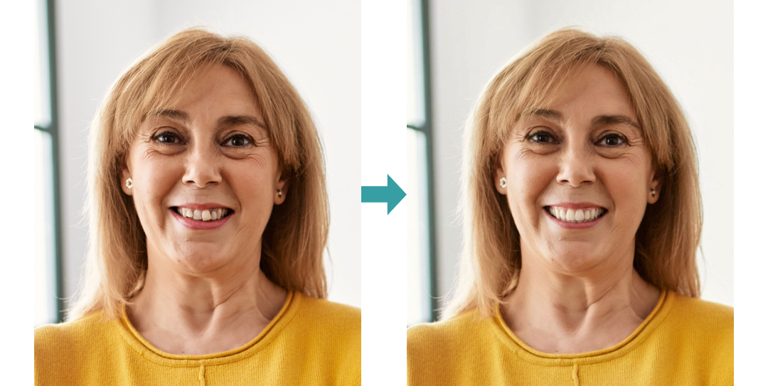 Before-and-after smile simulation — patient photo transformed into a natural, lifelike new smile