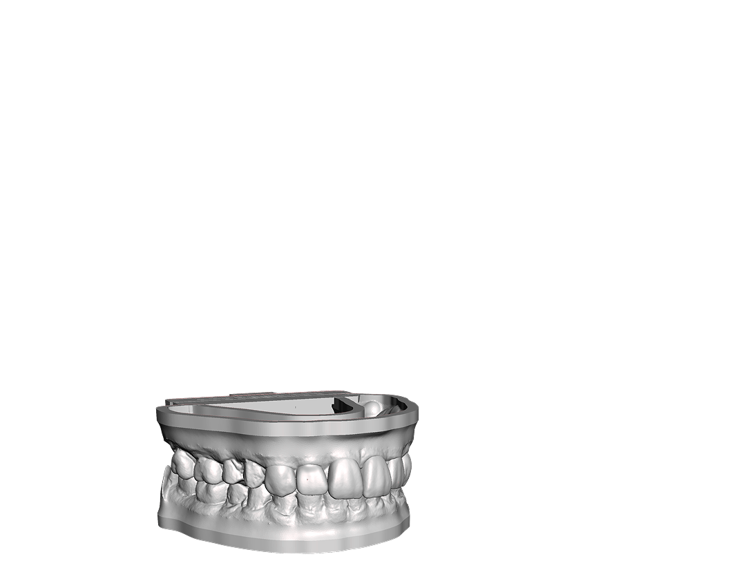 Printable 3D wax-up model generated from the smile design