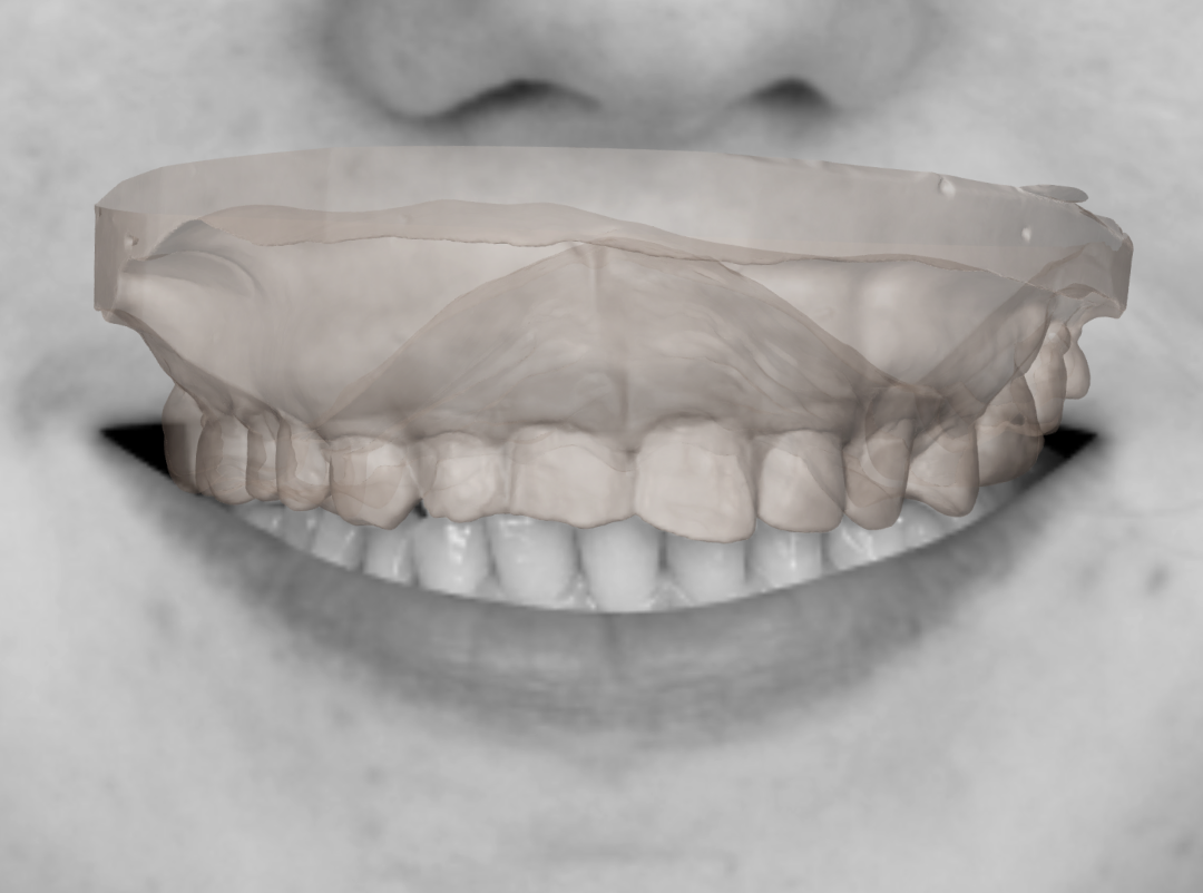 AI aligning the 2D patient photo onto the 3D dental scan