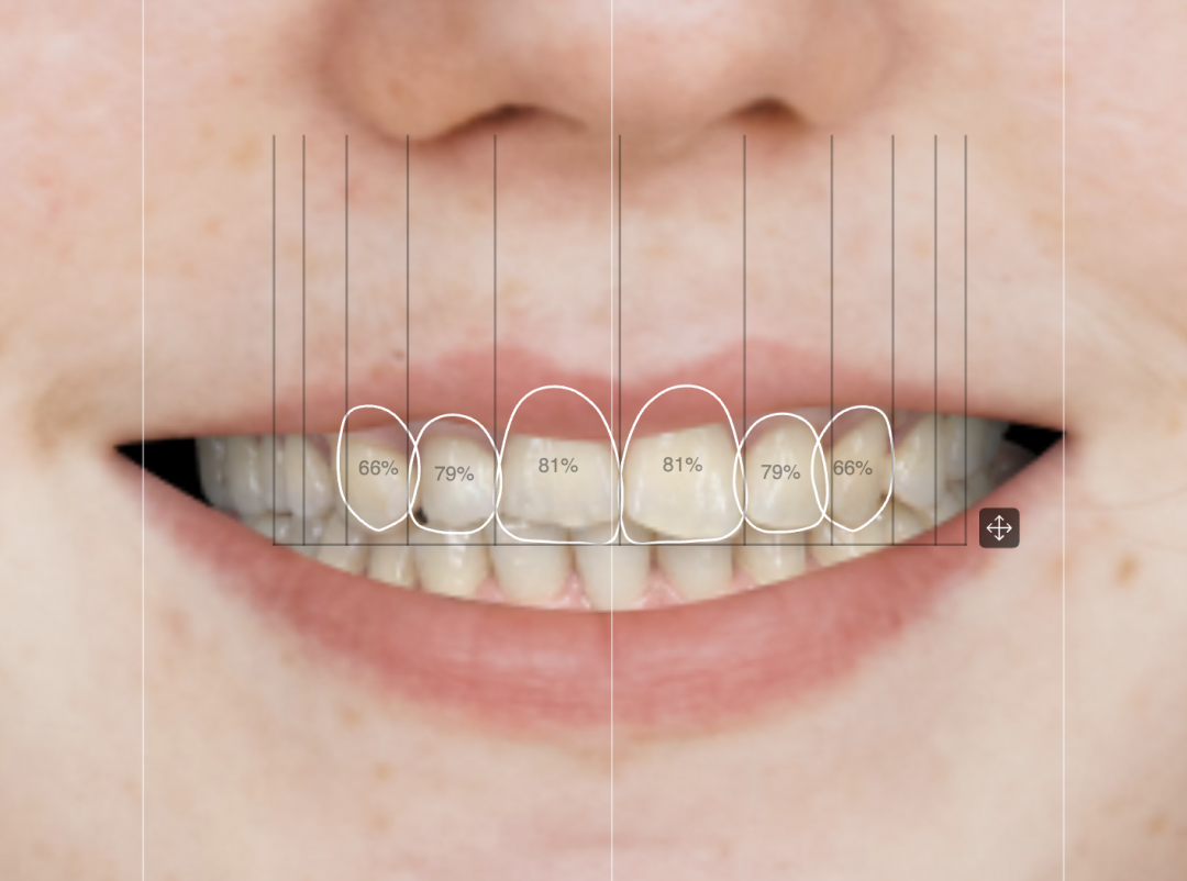 2D smile design on the patient photo with tooth outlines, proportion guides, and facial midline references