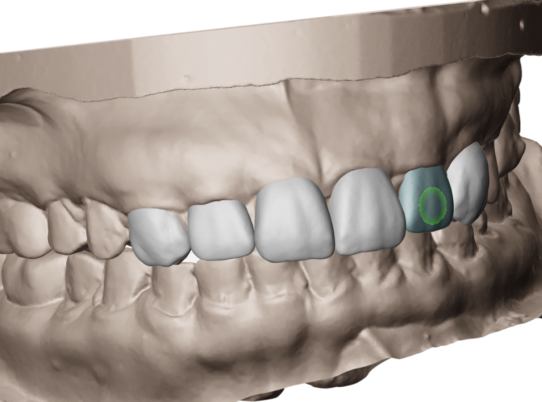 AI-generated 3D wax-up placed on the dental scan from the 2D smile design
