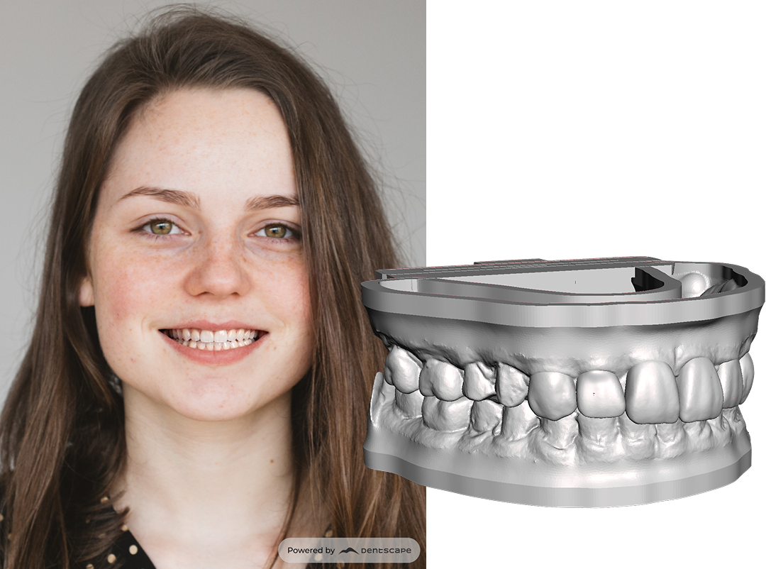 Final smile simulation portrait beside the ready-to-print 3D wax-up model